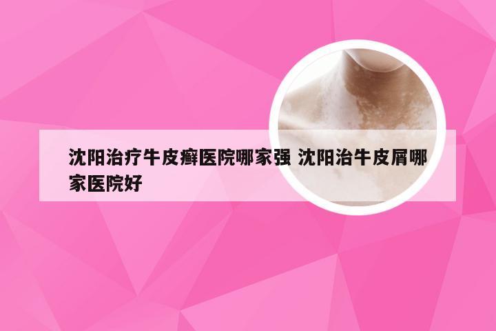 沈阳治疗牛皮癣医院哪家强 沈阳治牛皮屑哪家医院好