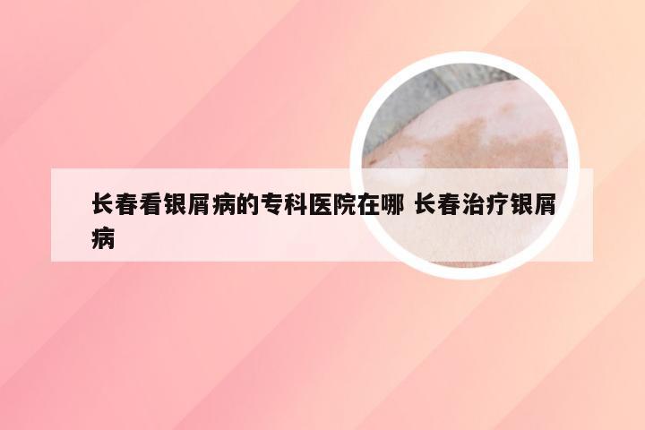 长春看银屑病的专科医院在哪 长春治疗银屑病