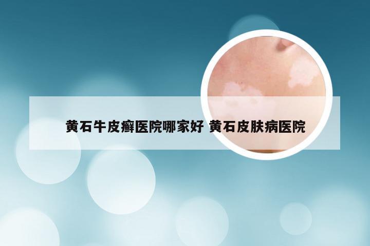 黄石牛皮癣医院哪家好 黄石皮肤病医院