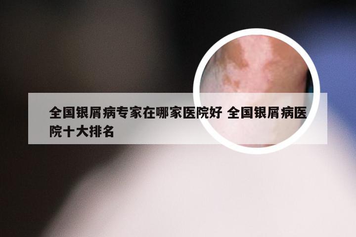 全国银屑病专家在哪家医院好 全国银屑病医院十大排名
