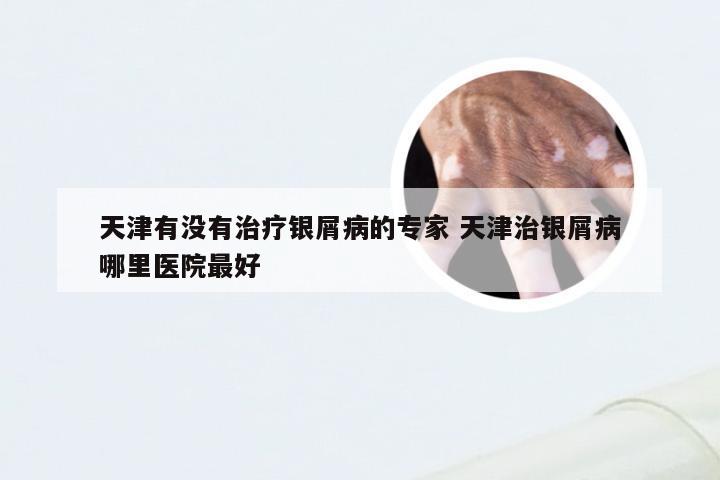 天津有没有治疗银屑病的专家 天津治银屑病哪里医院最好