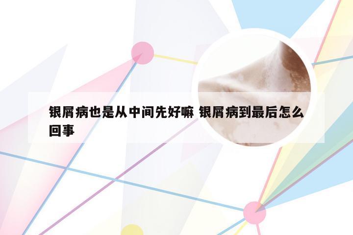 银屑病也是从中间先好嘛 银屑病到最后怎么回事