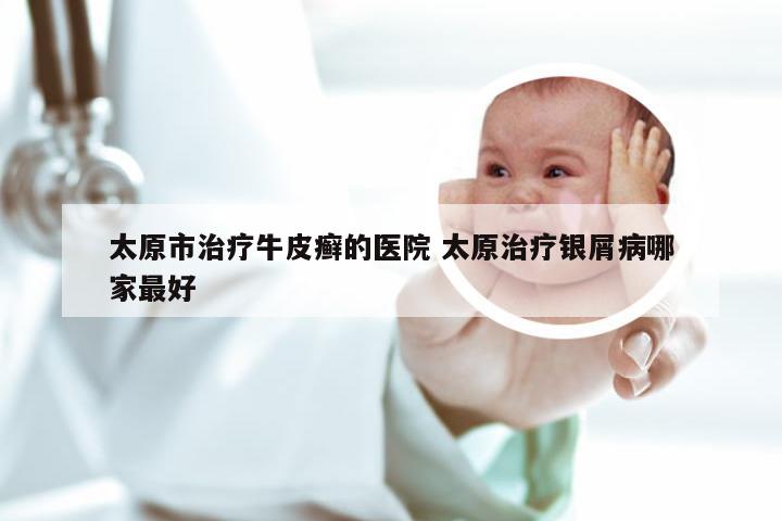 太原市治疗牛皮癣的医院 太原治疗银屑病哪家最好