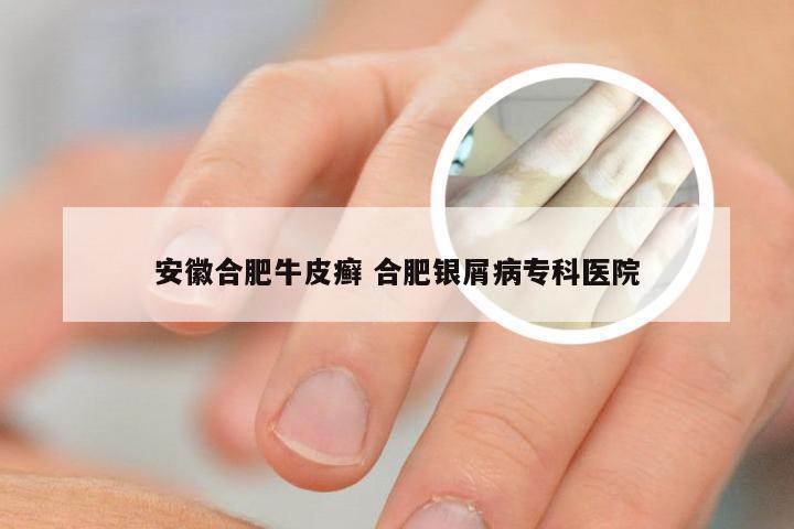 安徽合肥牛皮癣 合肥银屑病专科医院