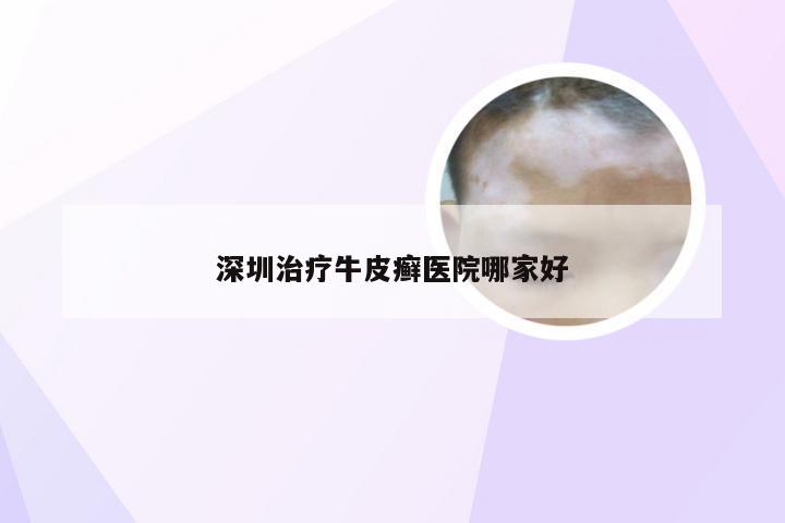 深圳治疗牛皮癣医院哪家好
