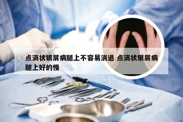 点滴状银屑病腿上不容易消退 点滴状银屑病腿上好的慢