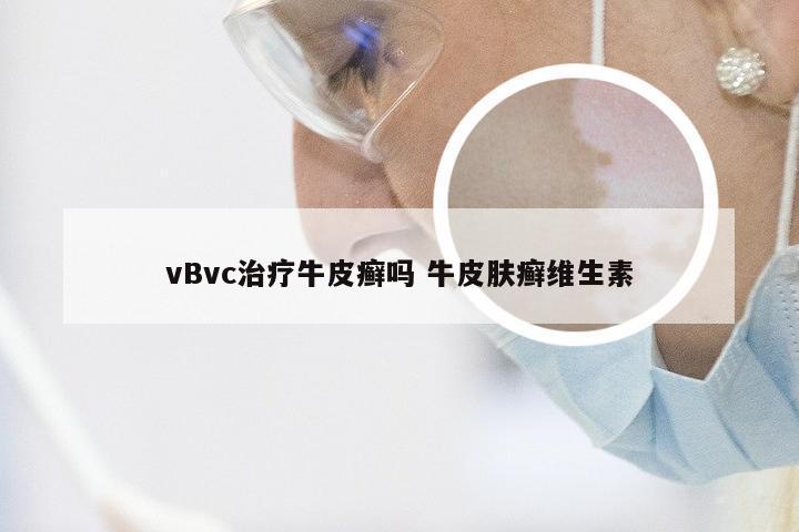 vBvc治疗牛皮癣吗 牛皮肤癣维生素