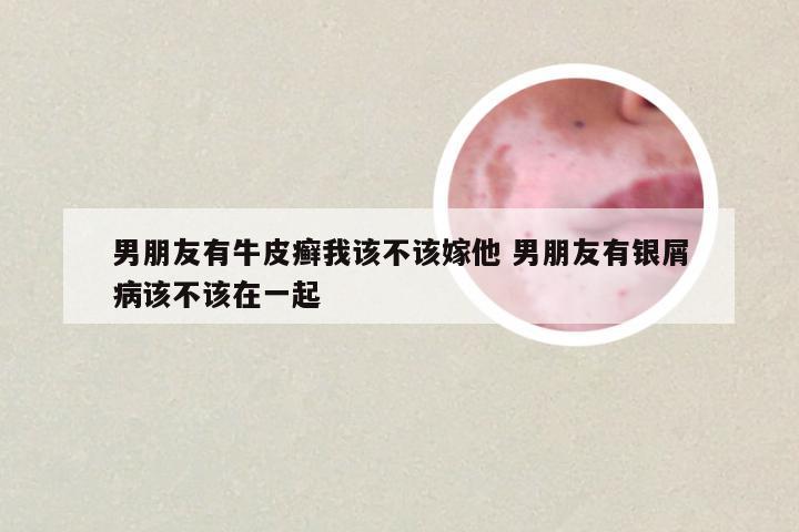 男朋友有牛皮癣我该不该嫁他 男朋友有银屑病该不该在一起