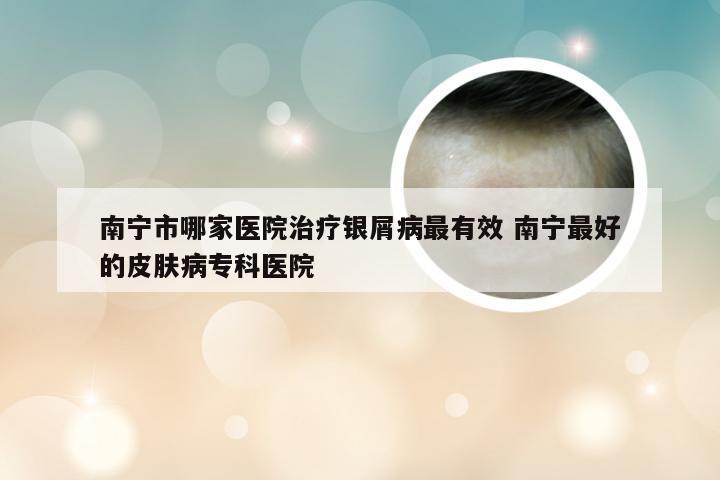 南宁市哪家医院治疗银屑病最有效 南宁最好的皮肤病专科医院