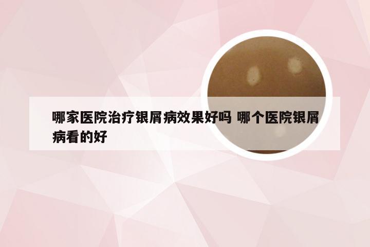 哪家医院治疗银屑病效果好吗 哪个医院银屑病看的好