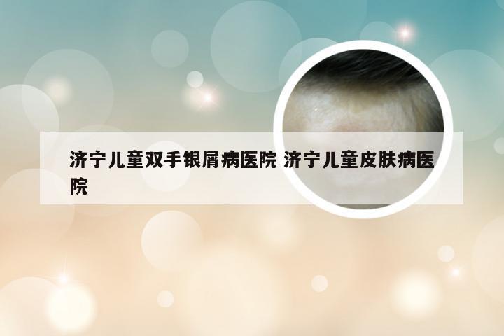 济宁儿童双手银屑病医院 济宁儿童皮肤病医院