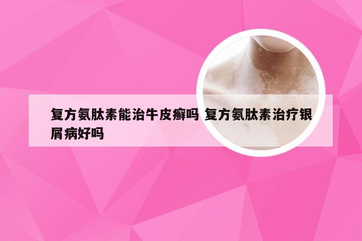 复方氨肽素能治牛皮癣吗 复方氨肽素治疗银屑病好吗