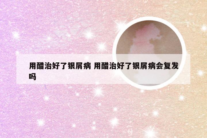 用醋治好了银屑病 用醋治好了银屑病会复发吗