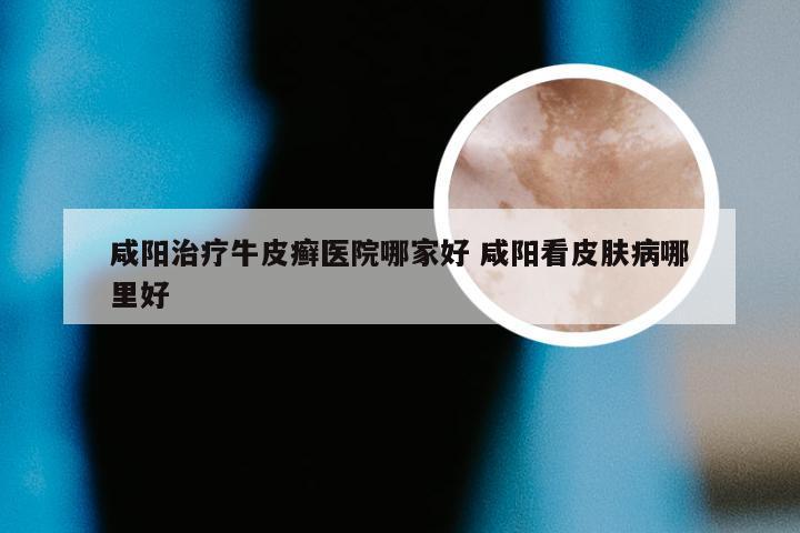 咸阳治疗牛皮癣医院哪家好 咸阳看皮肤病哪里好