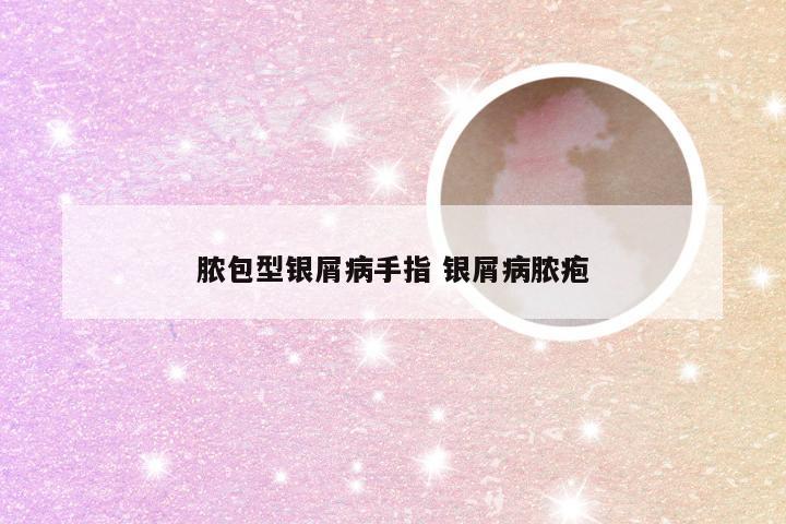 脓包型银屑病手指 银屑病脓疱