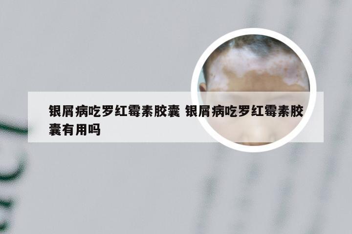 银屑病吃罗红霉素胶囊 银屑病吃罗红霉素胶囊有用吗