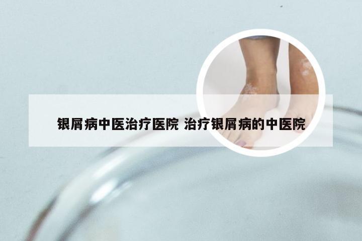 银屑病中医治疗医院 治疗银屑病的中医院