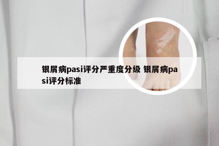 银屑病pasi评分严重度分级 银屑病pasi评分标准