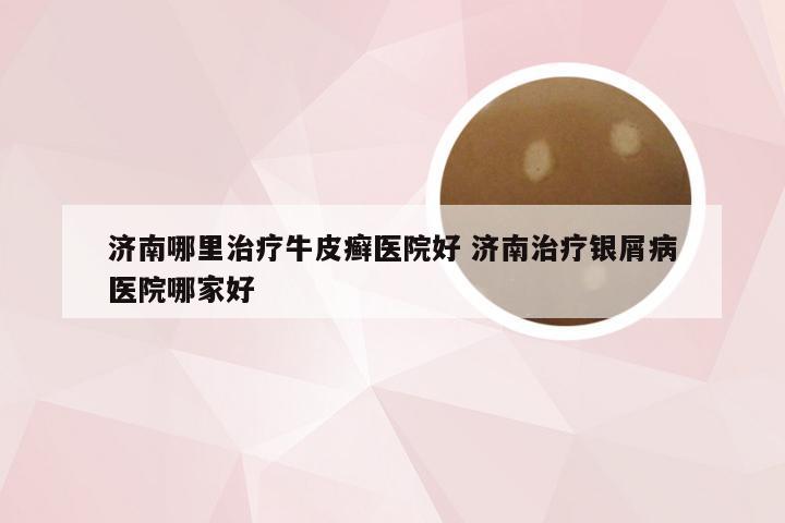 济南哪里治疗牛皮癣医院好 济南治疗银屑病医院哪家好