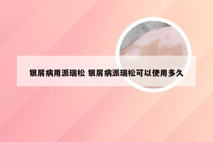 银屑病用派瑞松 银屑病派瑞松可以使用多久