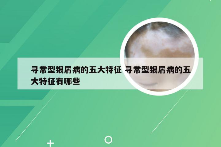 寻常型银屑病的五大特征 寻常型银屑病的五大特征有哪些