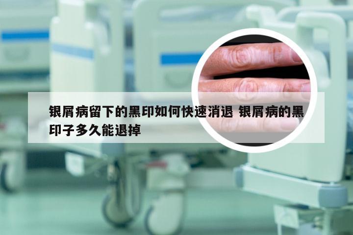 银屑病留下的黑印如何快速消退 银屑病的黑印子多久能退掉