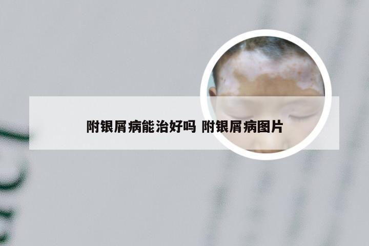 附银屑病能治好吗 附银屑病图片