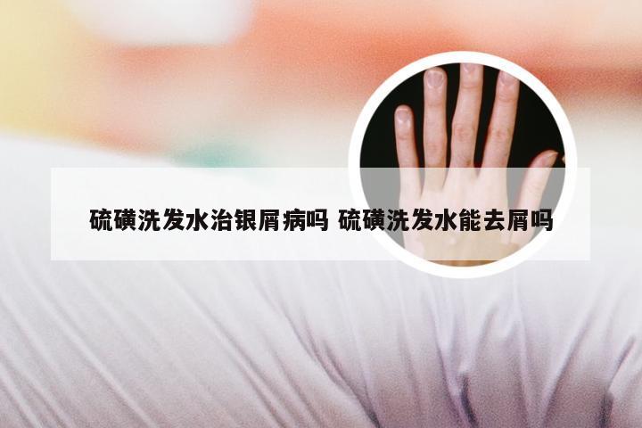硫磺洗发水治银屑病吗 硫磺洗发水能去屑吗