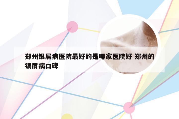 郑州银屑病医院最好的是哪家医院好 郑州的银屑病口碑