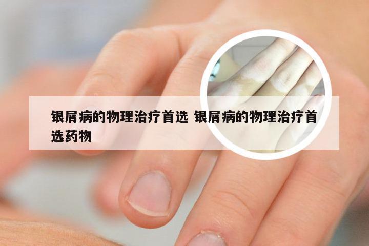 银屑病的物理治疗首选 银屑病的物理治疗首选药物