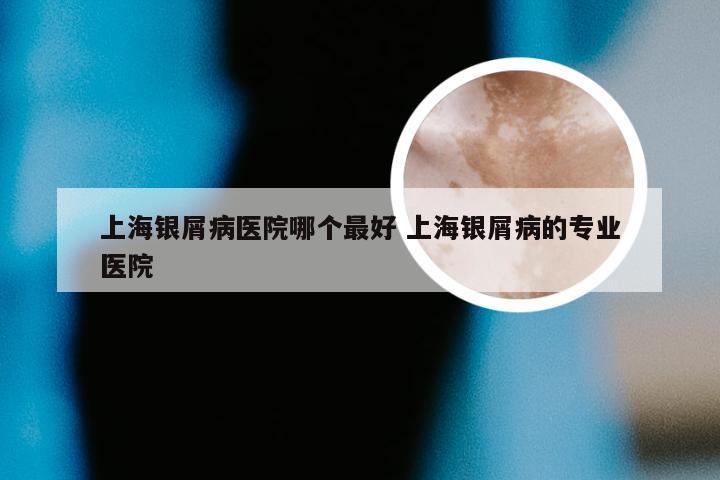 上海银屑病医院哪个最好 上海银屑病的专业医院