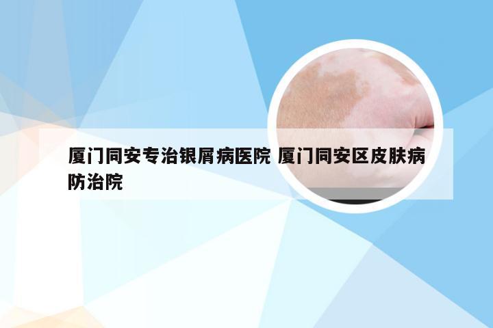 厦门同安专治银屑病医院 厦门同安区皮肤病防治院