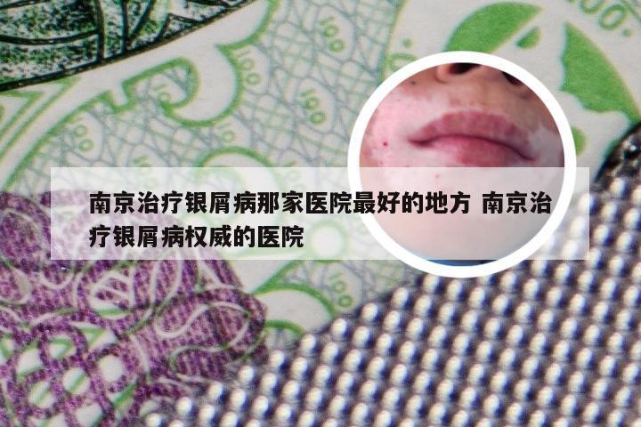 南京治疗银屑病那家医院最好的地方 南京治疗银屑病权威的医院