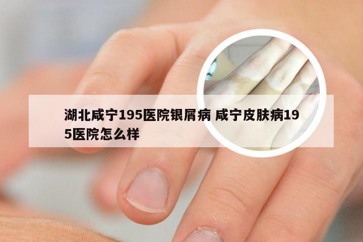 湖北咸宁195医院银屑病 咸宁皮肤病195医院怎么样