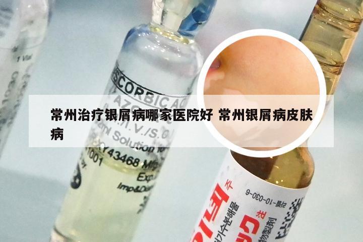 常州治疗银屑病哪家医院好 常州银屑病皮肤病