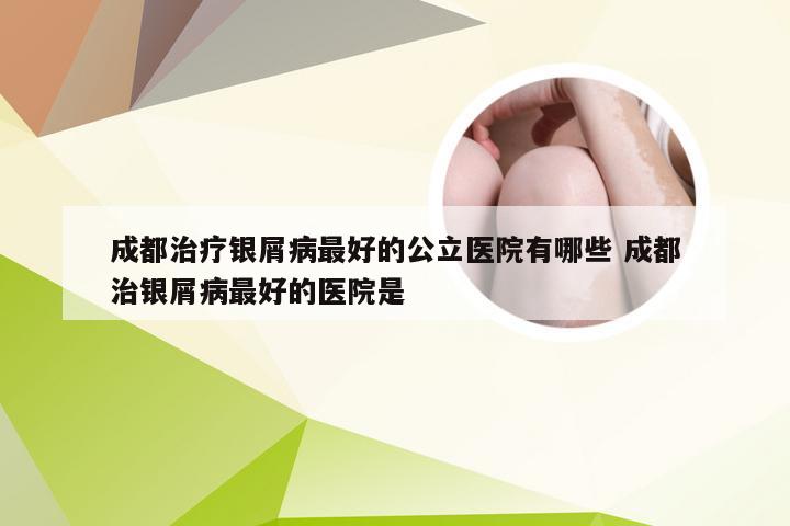 成都治疗银屑病最好的公立医院有哪些 成都治银屑病最好的医院是