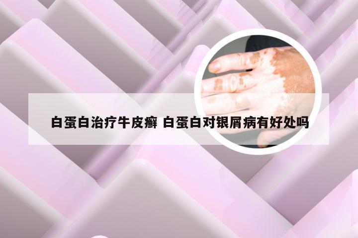 白蛋白治疗牛皮癣 白蛋白对银屑病有好处吗