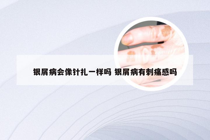 银屑病会像针扎一样吗 银屑病有刺痛感吗