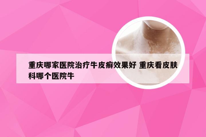 重庆哪家医院治疗牛皮癣效果好 重庆看皮肤科哪个医院牛