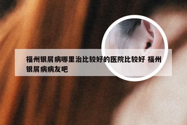 福州银屑病哪里治比较好的医院比较好 福州银屑病病友吧