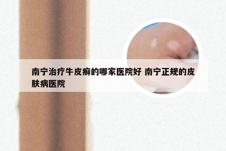 南宁治疗牛皮癣的哪家医院好 南宁正规的皮肤病医院