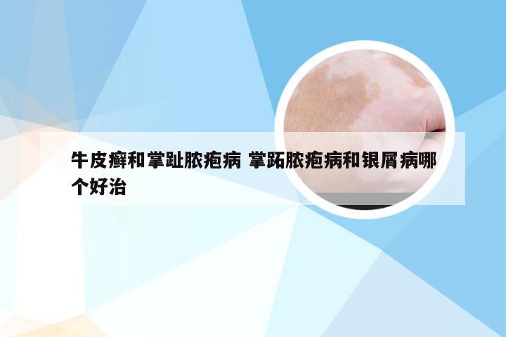 牛皮癣和掌趾脓疱病 掌跖脓疱病和银屑病哪个好治