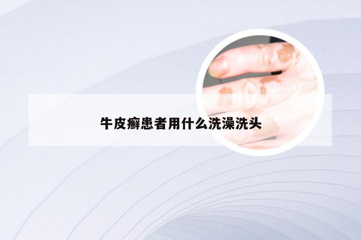 牛皮癣患者用什么洗澡洗头