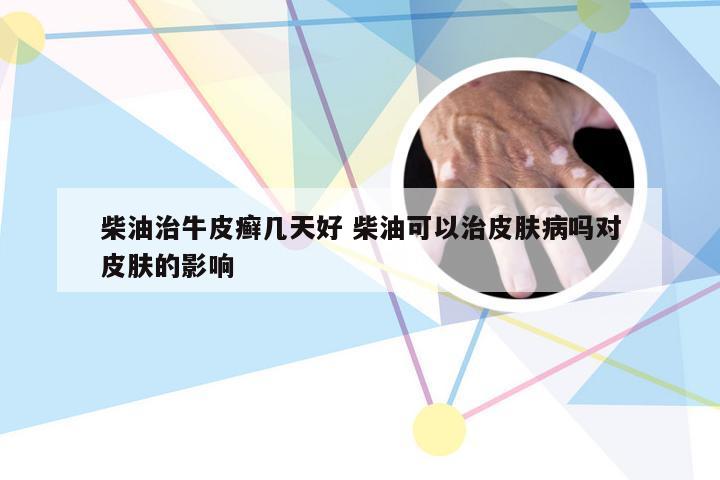 柴油治牛皮癣几天好 柴油可以治皮肤病吗对皮肤的影响