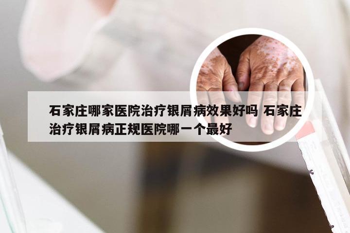 石家庄哪家医院治疗银屑病效果好吗 石家庄治疗银屑病正规医院哪一个最好