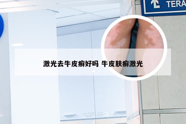 激光去牛皮癣好吗 牛皮肤癣激光