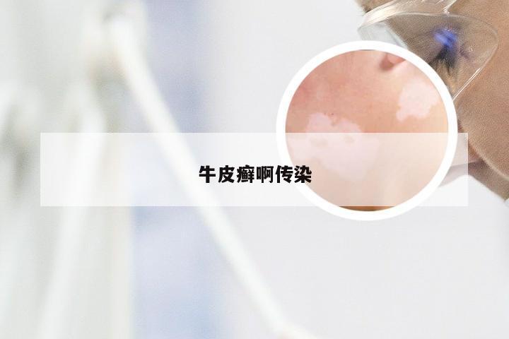 牛皮癣啊传染