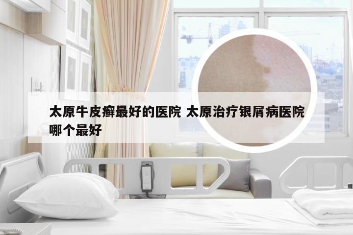 太原牛皮癣最好的医院 太原治疗银屑病医院哪个最好