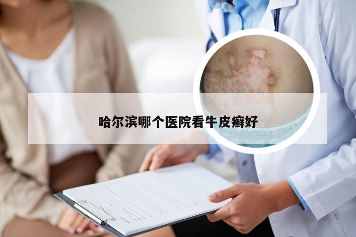 哈尔滨哪个医院看牛皮癣好