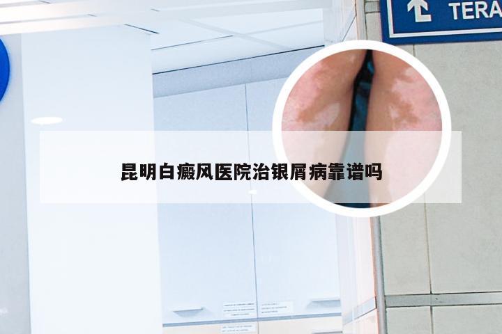 昆明白癜风医院治银屑病靠谱吗